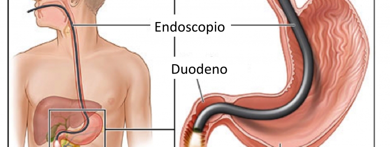 A quién, cómo y por qué realizar un estudio endoscópico?